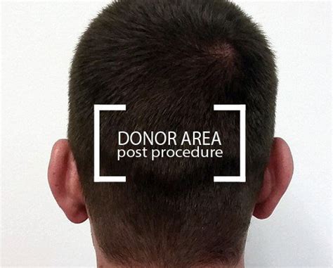 hair transplant st louis|Follicular Unit Extraction (FUE) .